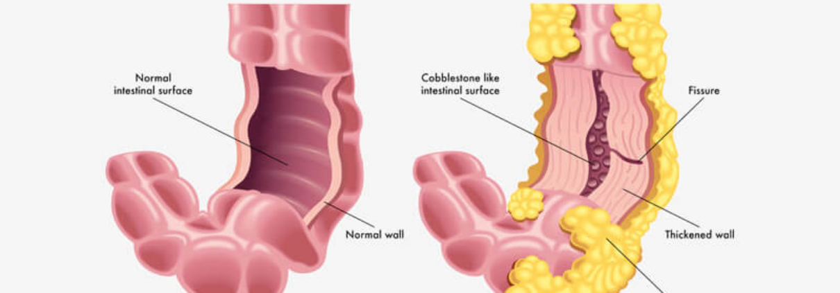 Risk-Alleles-for-Crohn’s-Disease