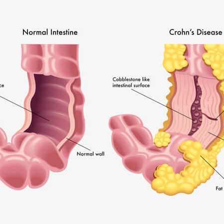 Risk-Alleles-for-Crohn’s-Disease