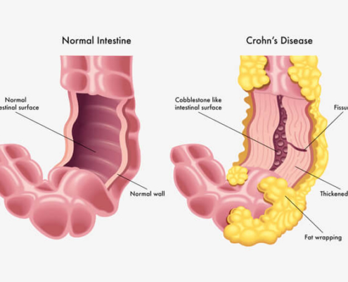 Risk-Alleles-for-Crohn’s-Disease