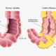 Risk-Alleles-for-Crohn’s-Disease